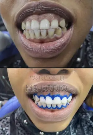 Teeth Whitening Service