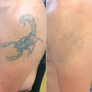 Tattoo Removal,Eye Brows Remove,Black Doll Treatment Etc