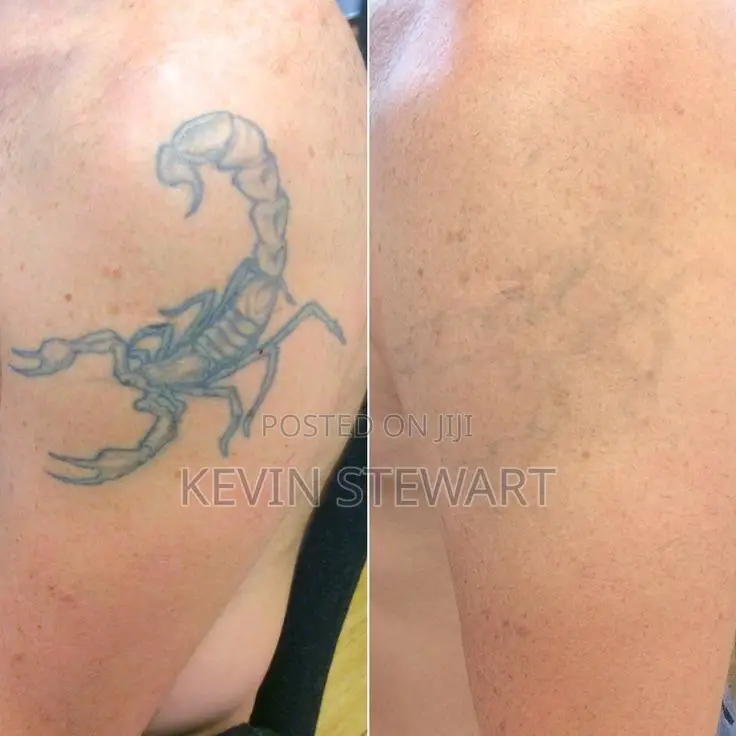 Tattoo Removal,Eye Brows Remove,Black Doll Treatment Etc