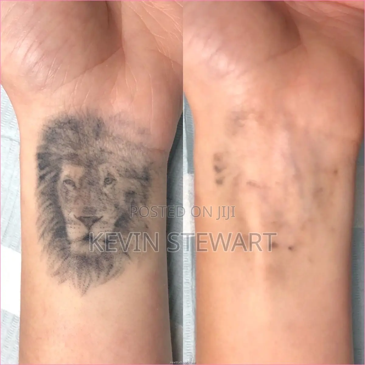 Tattoo Removal,Eye Brows Remove,Black Doll Treatment Etc