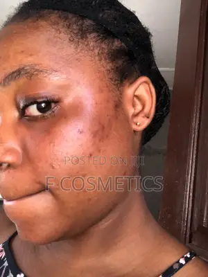 Are You Battling With Sunburn, Hyperpigmentation