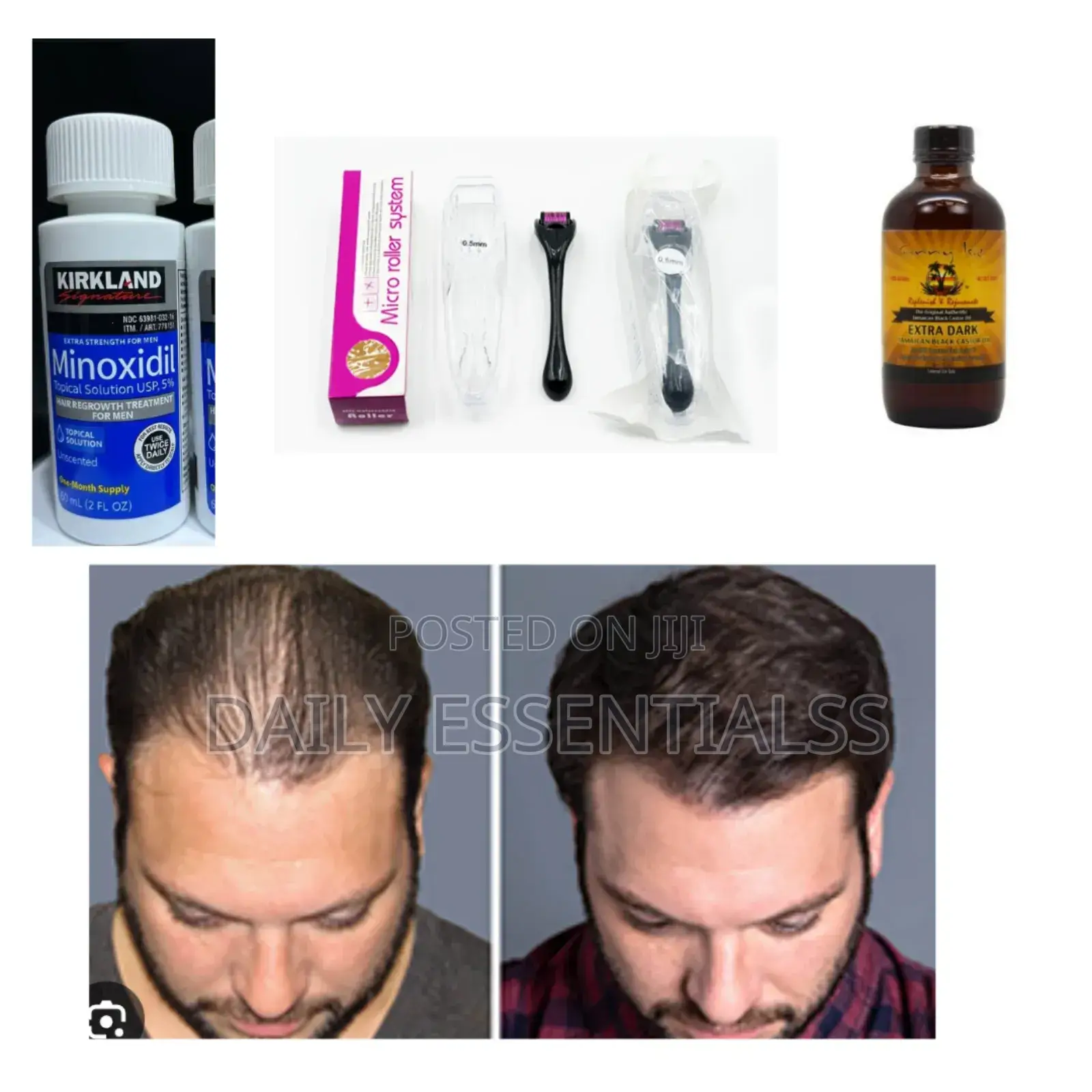 Balding? Thinning? This Set Is for You!