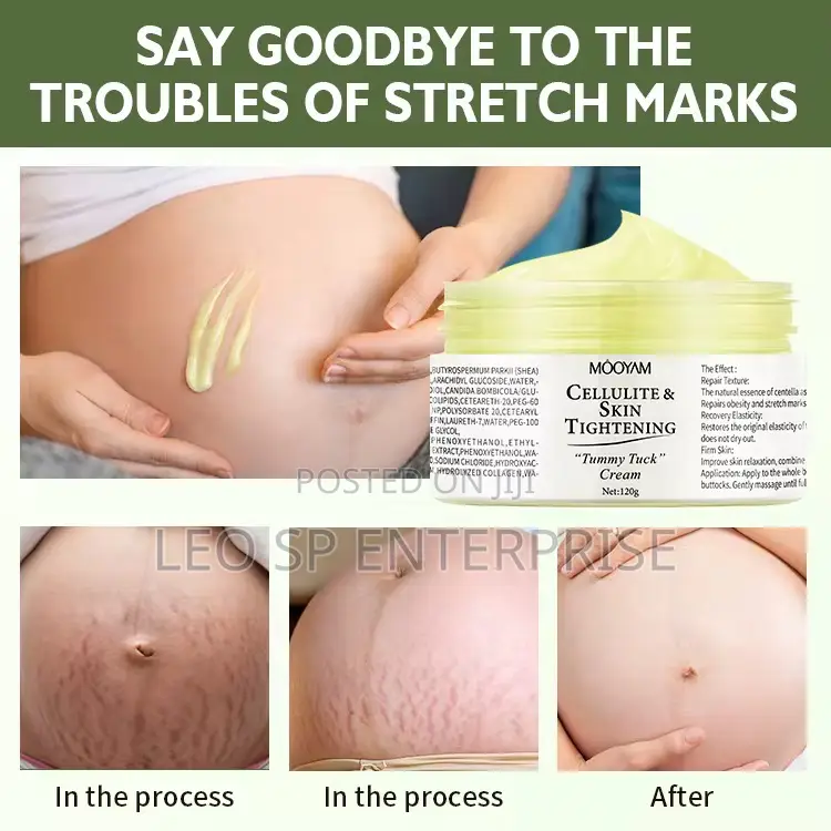 Mooyam Stretch Marks and After Pregnancy Cream