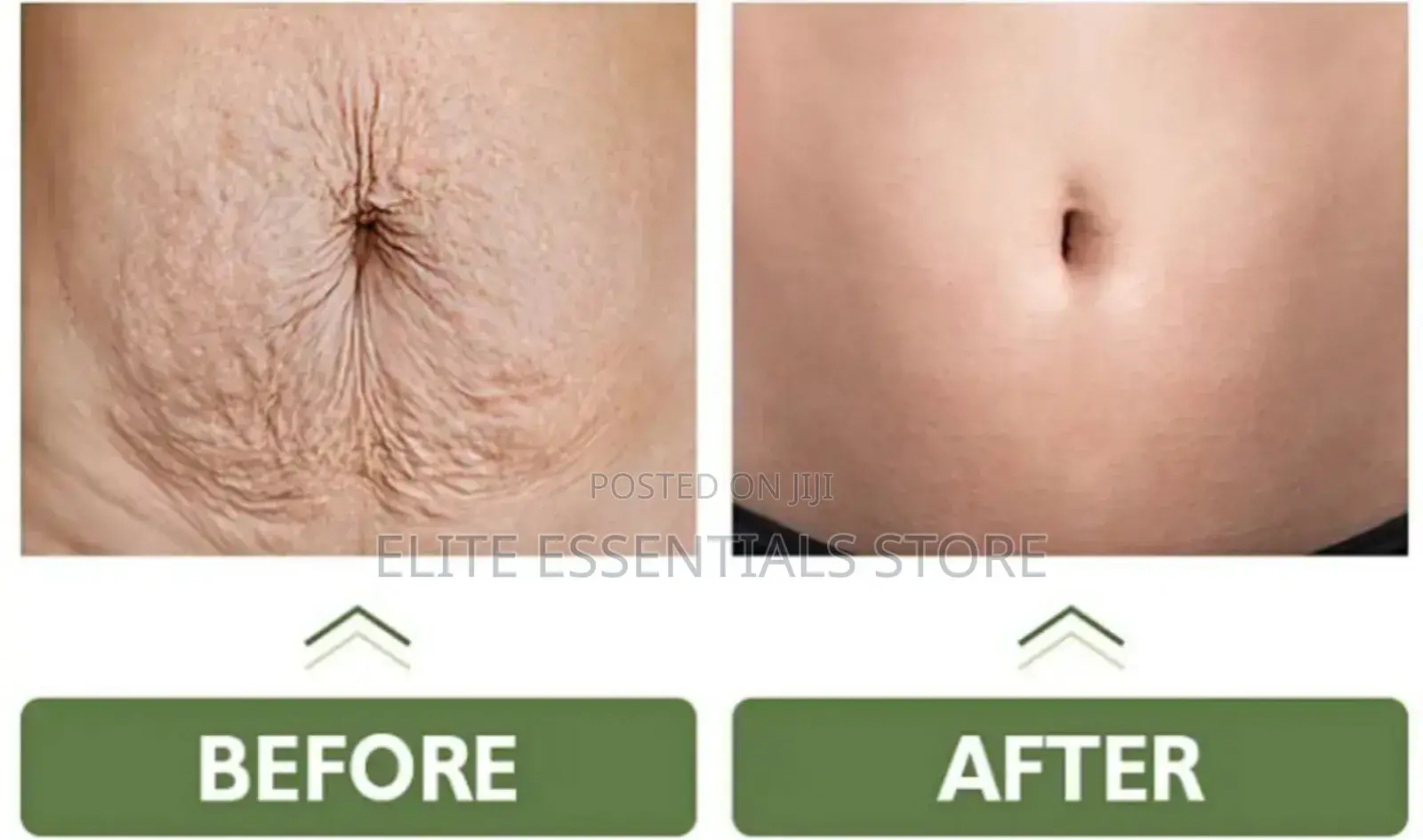 Tummy Tuck Stretch Marks Removal Skin Tightening Cream
