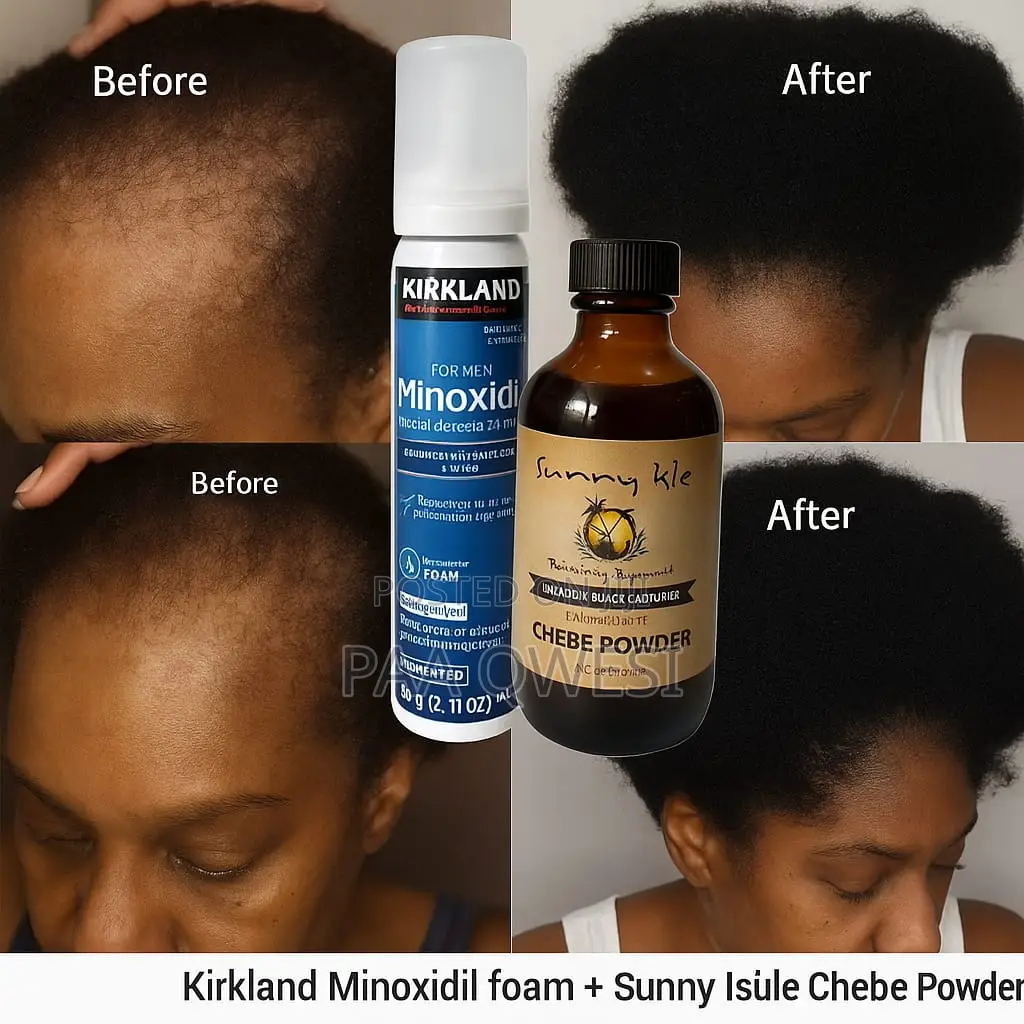 Chebe Powder + Kirkland Minoxidil Foam