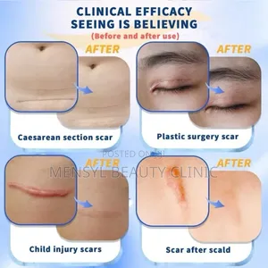 Dermatix Ultra Advanced Scar Gel Cutsburns,C-Section Keloid