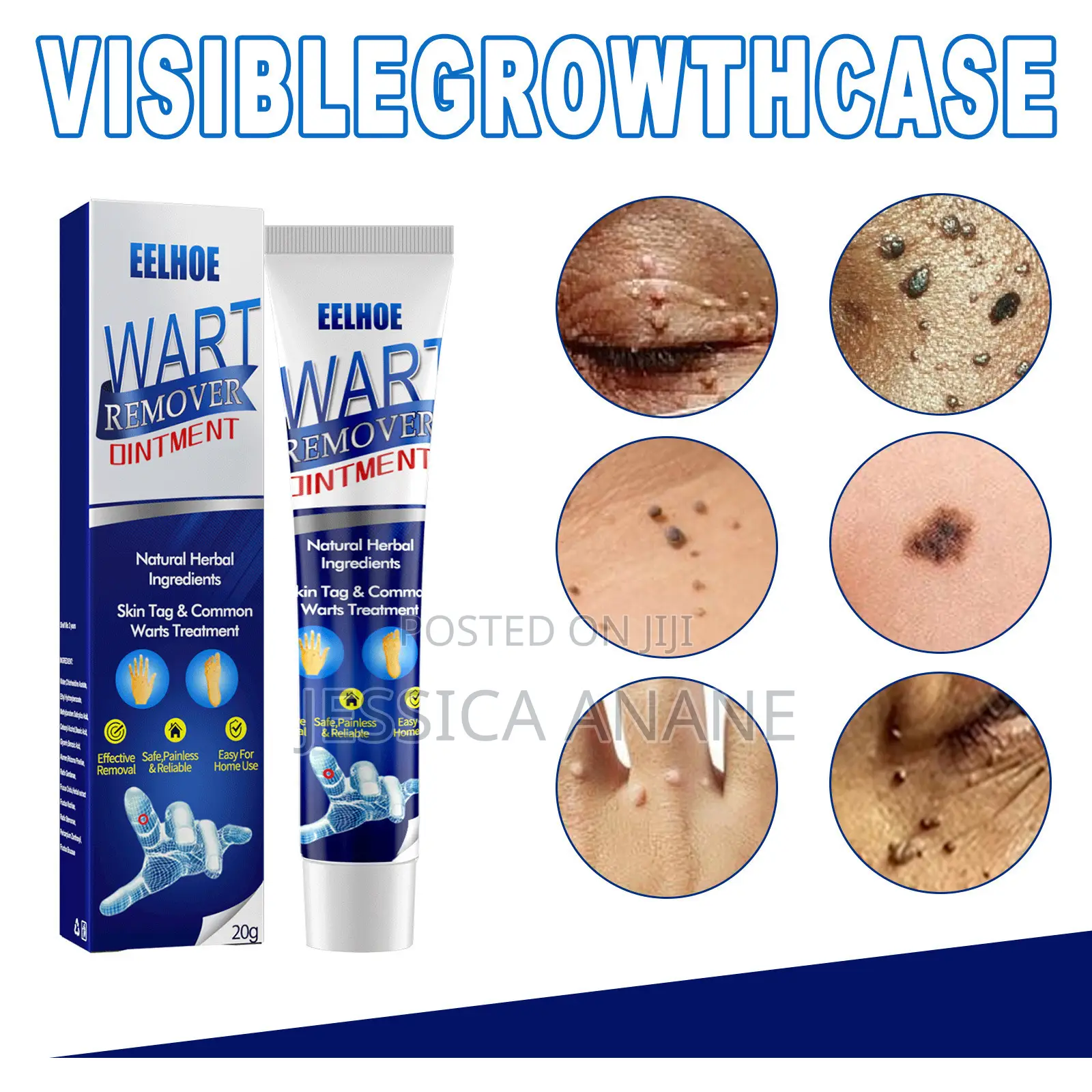 Eelhoe Skin Tags and Warts Remover Ointment