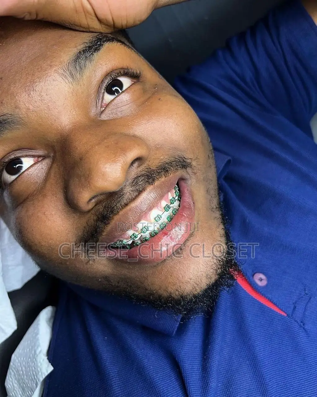 Fashion Braces( Glue-Type)