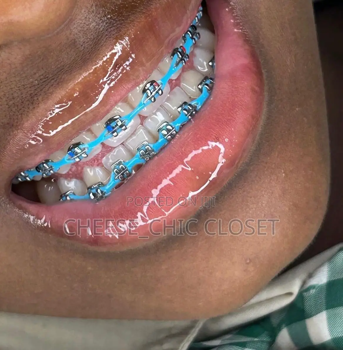 Fashion Braces( Glue-Type)
