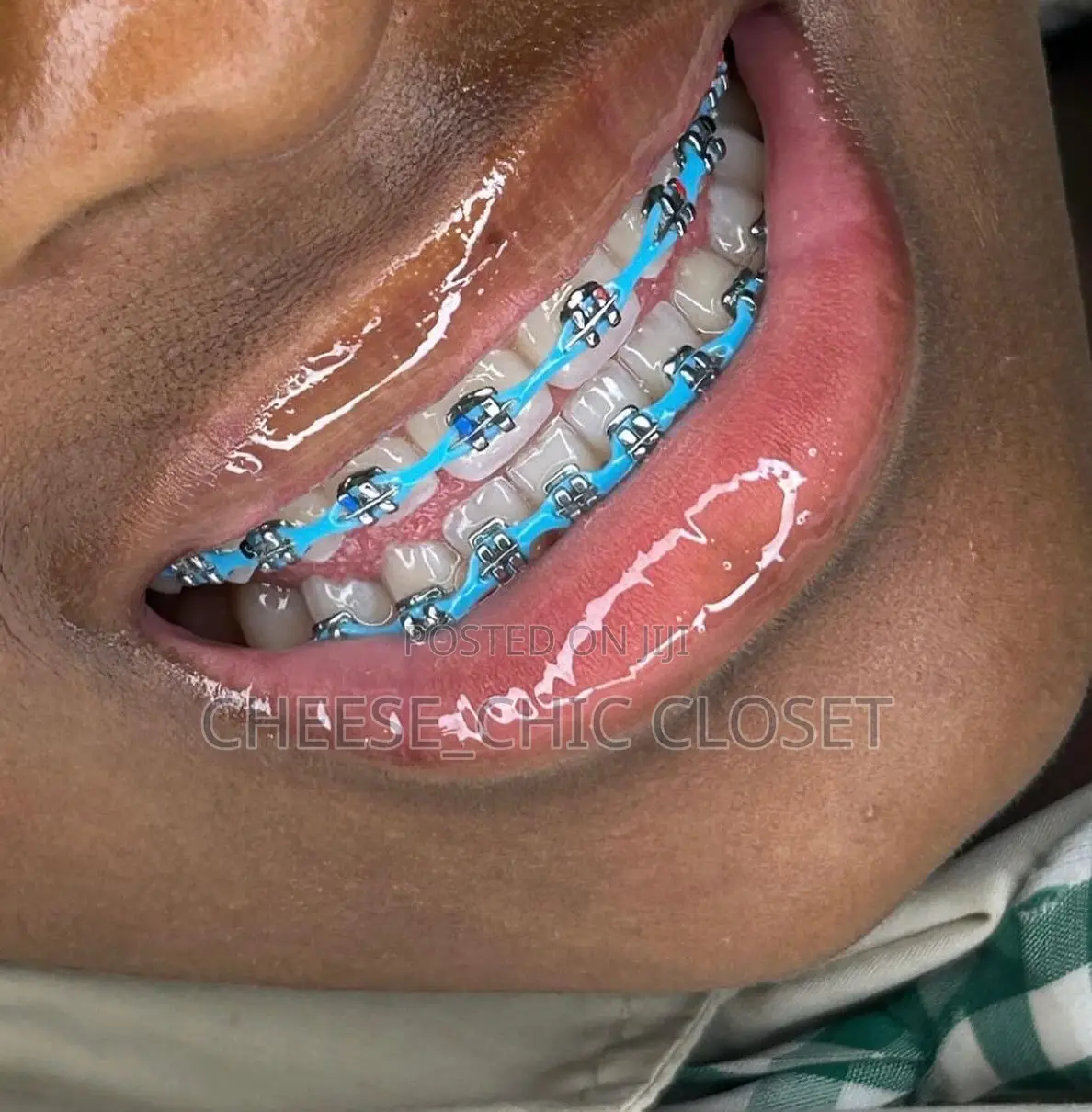 Fashion Braces( Glue-Type)