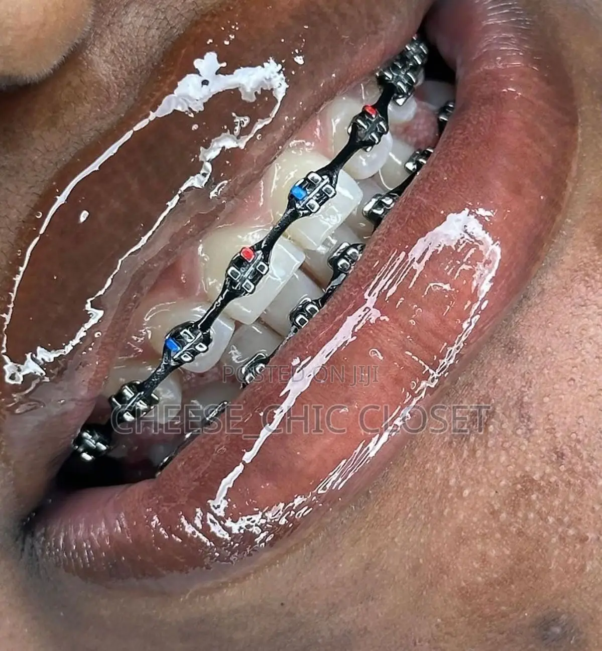 Fashion Braces( Glue-Type)