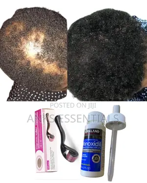 Kirkland Hair Regrowth Oil + Derma Roller for Thicker Hair
