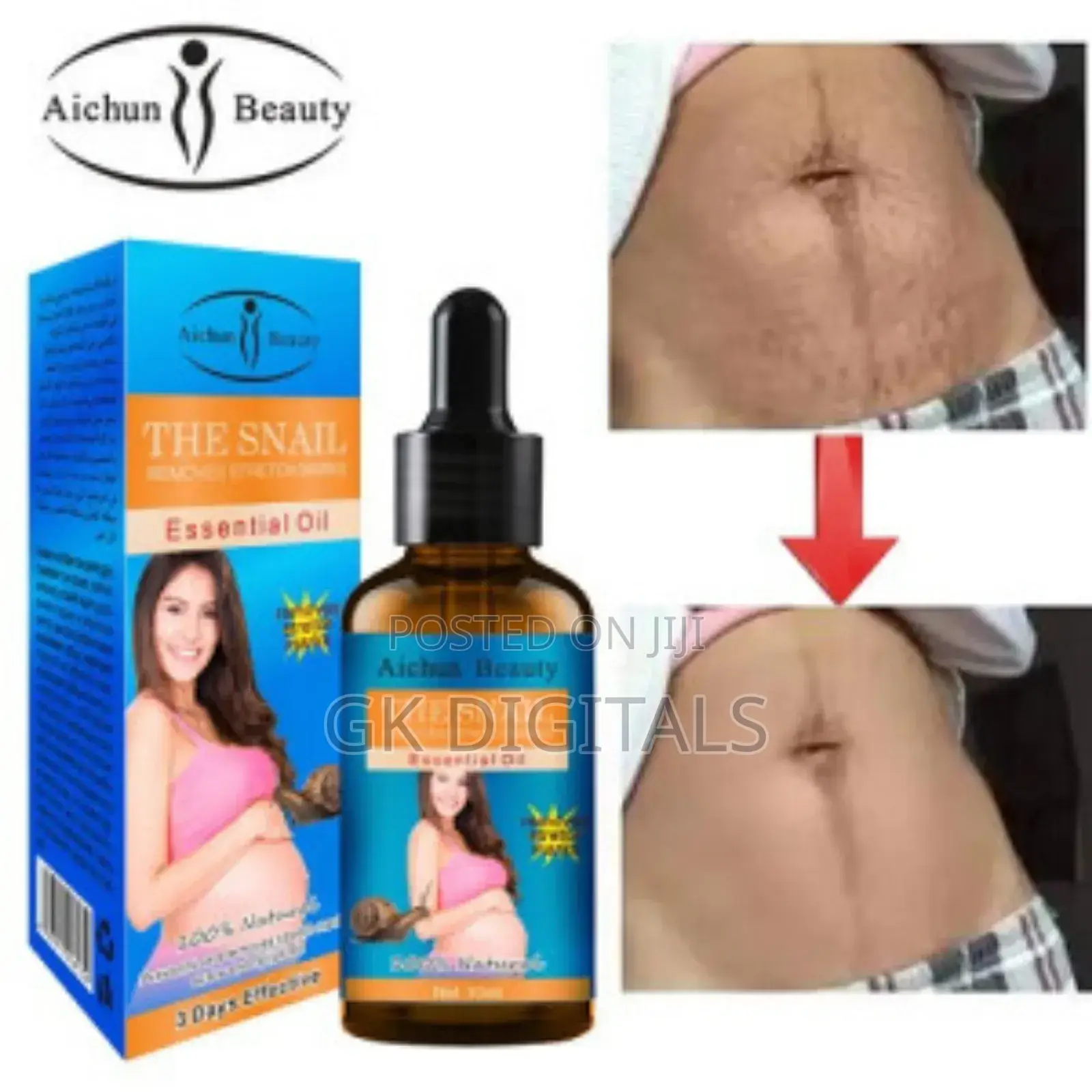 Stretch Marks Removal in a Few Week