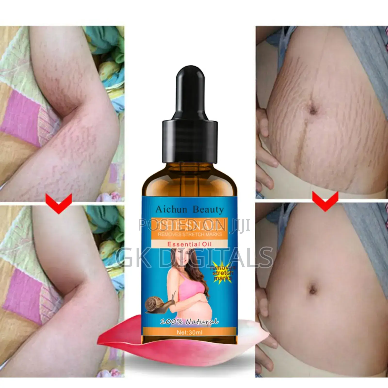 Stretch Marks Removal in a Few Week