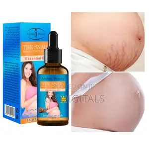Stretch Marks Removal in a Few Week