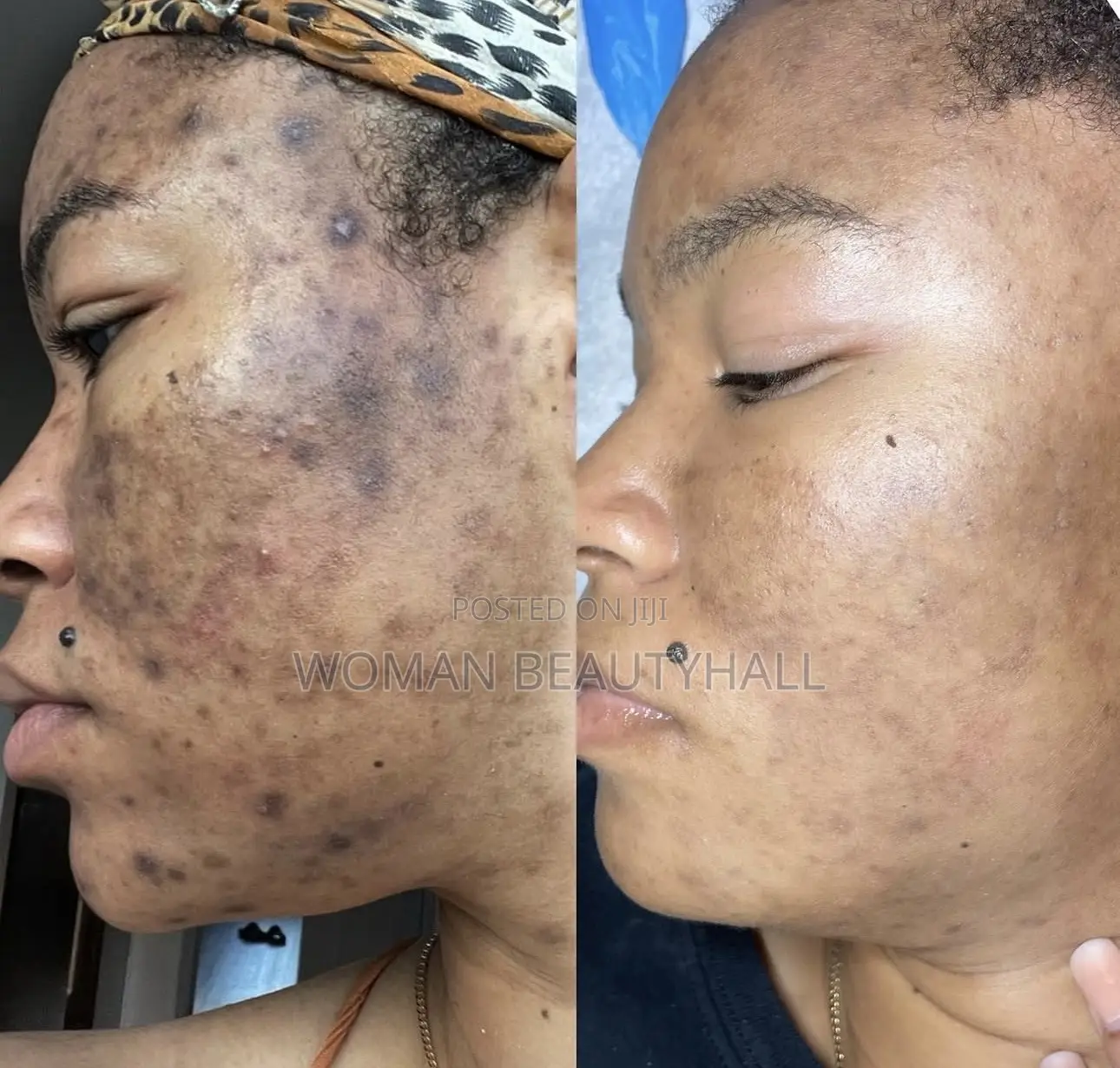 Dark Sports and Hyperpigmentation Treatment