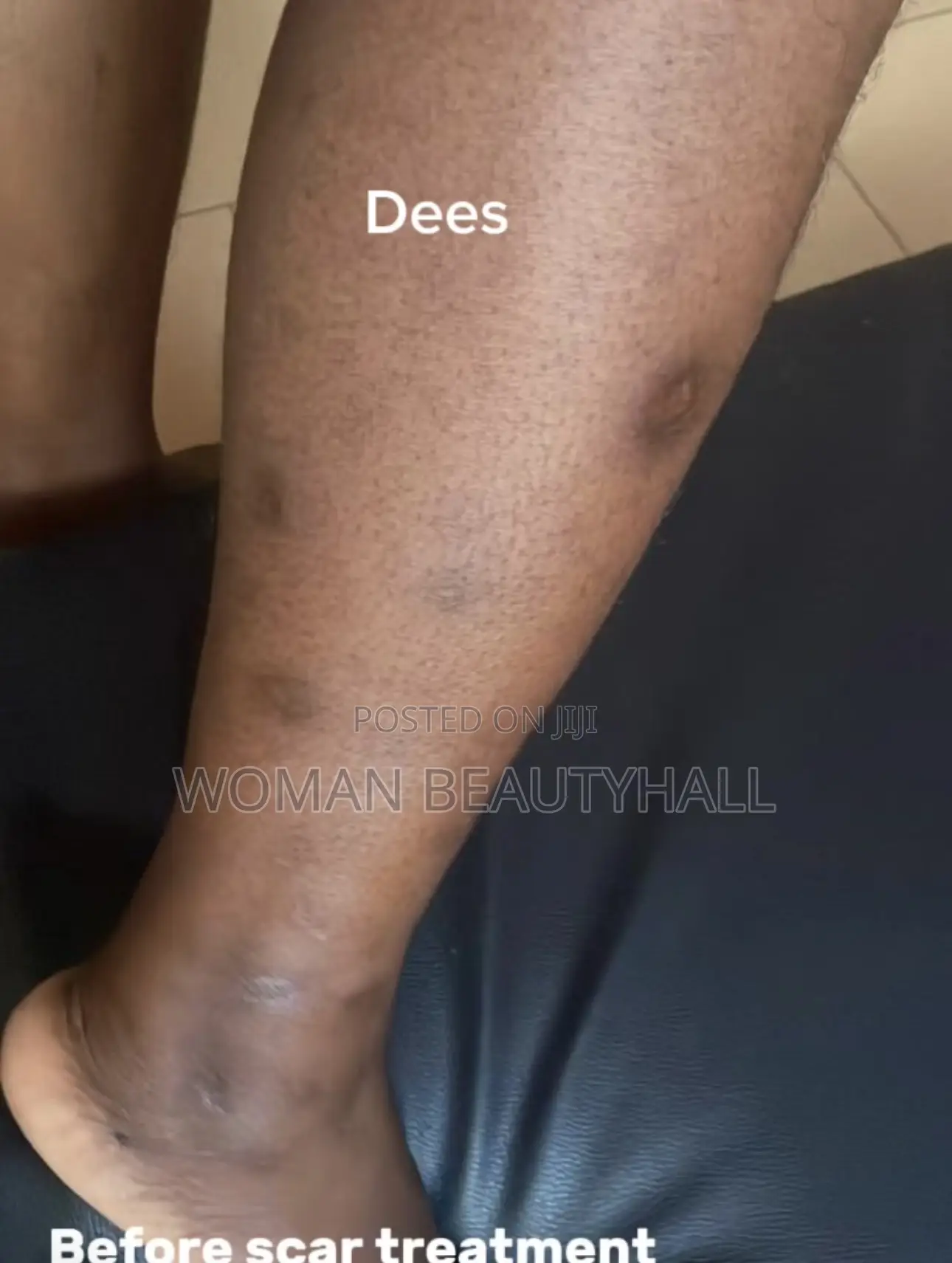 Advance Laser Scar Treatment