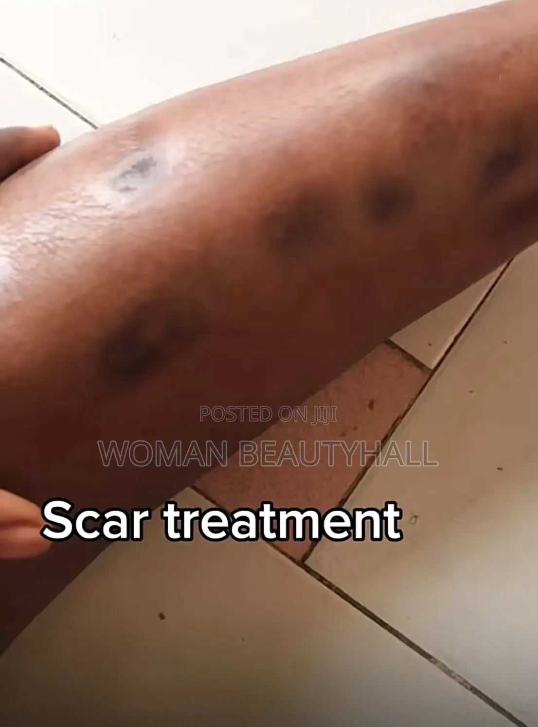 Advance Laser Scar Treatment