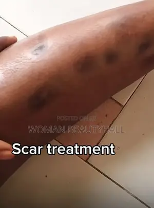 Advance Laser Scar Treatment