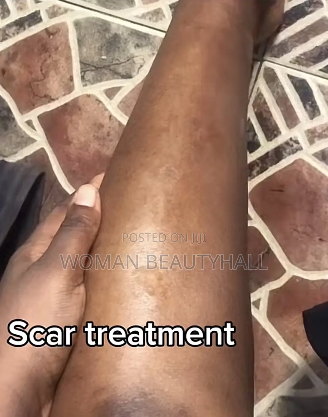 Advance Laser Scar Treatment