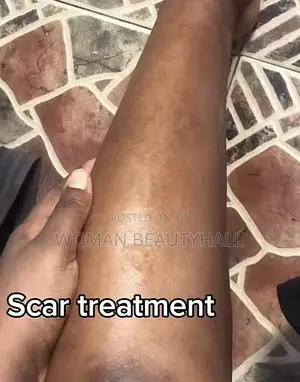 Advance Laser Scar Treatment