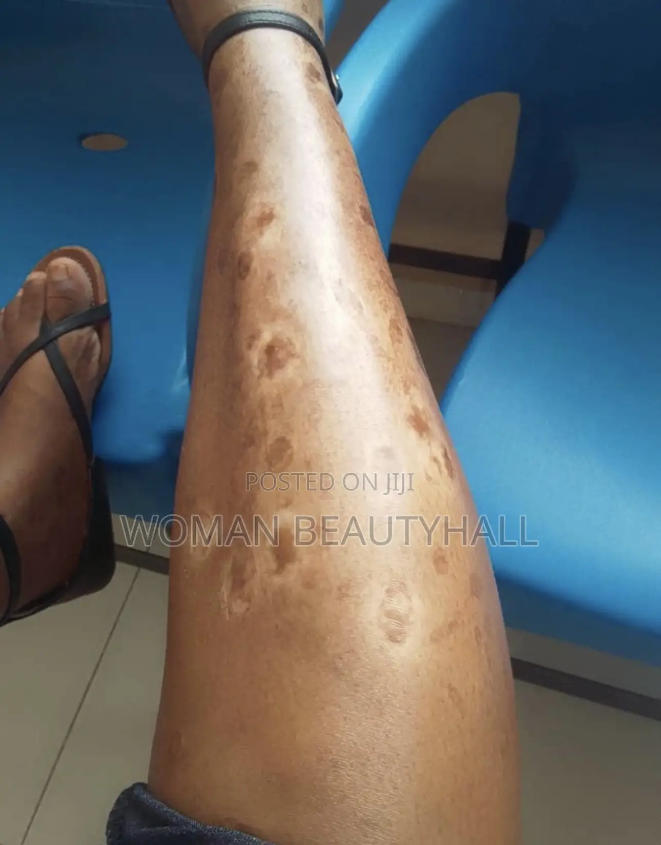 Advance Laser Scar Treatment