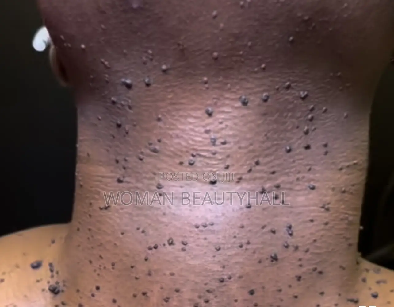 Skin Tag / DPN Removal