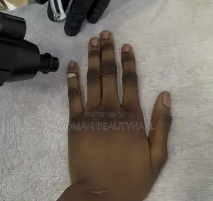 Dark Knuckles Laser Treatment