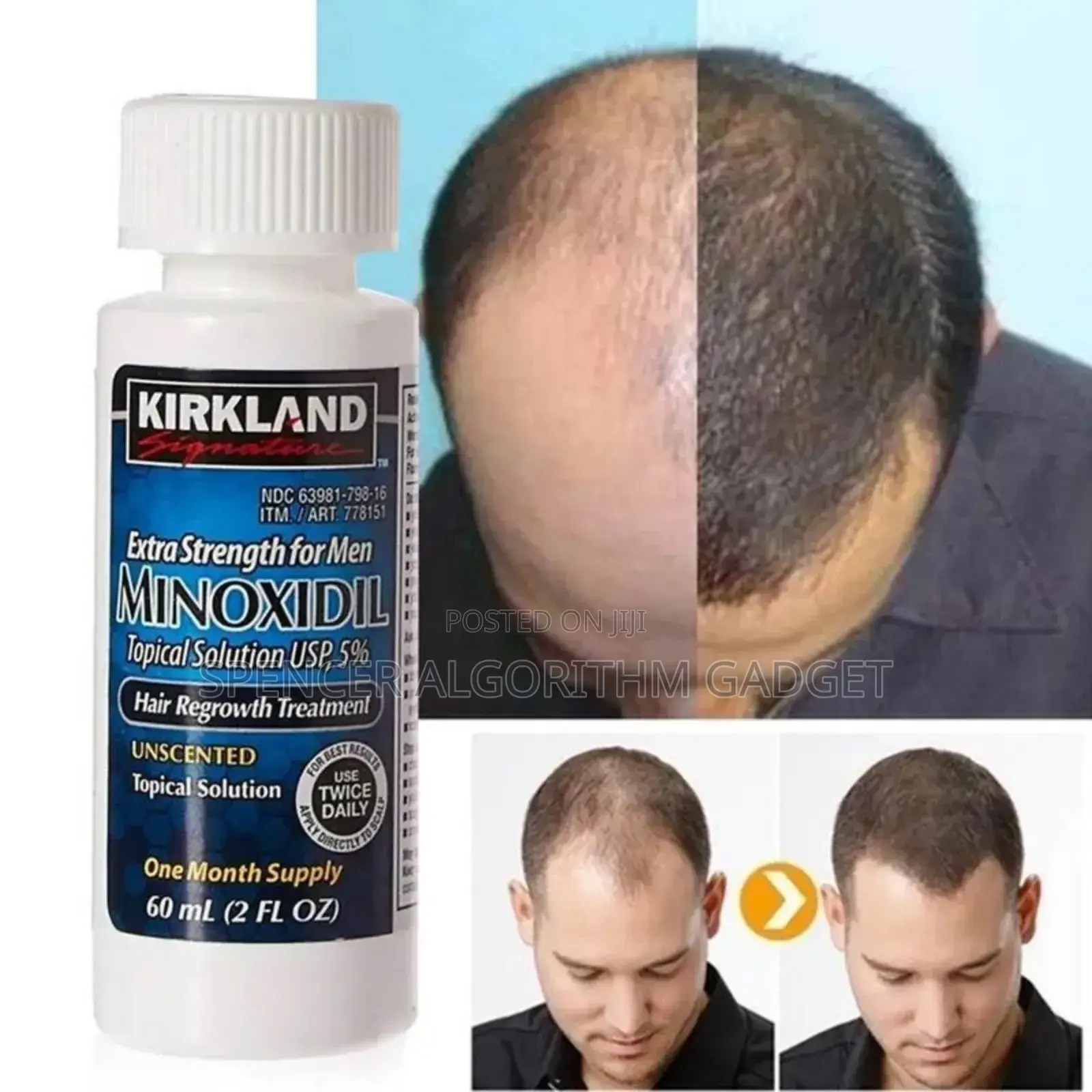 Kirkland Minoxidil 5% Hair Growth Treatment 60ml