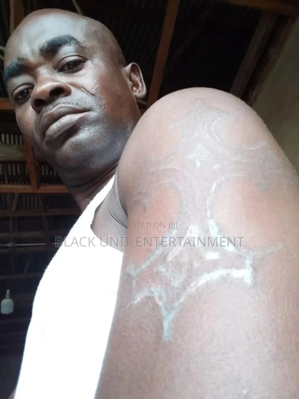 Tattoo Removal