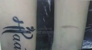 Tattoo Removal