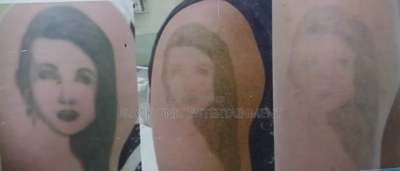 Tattoo Removal