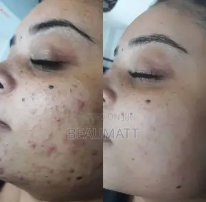 Derma Roller For Hair Growth And Face Care