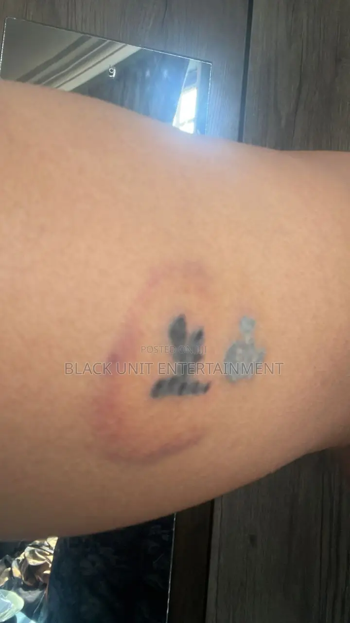 Tattoo Removal