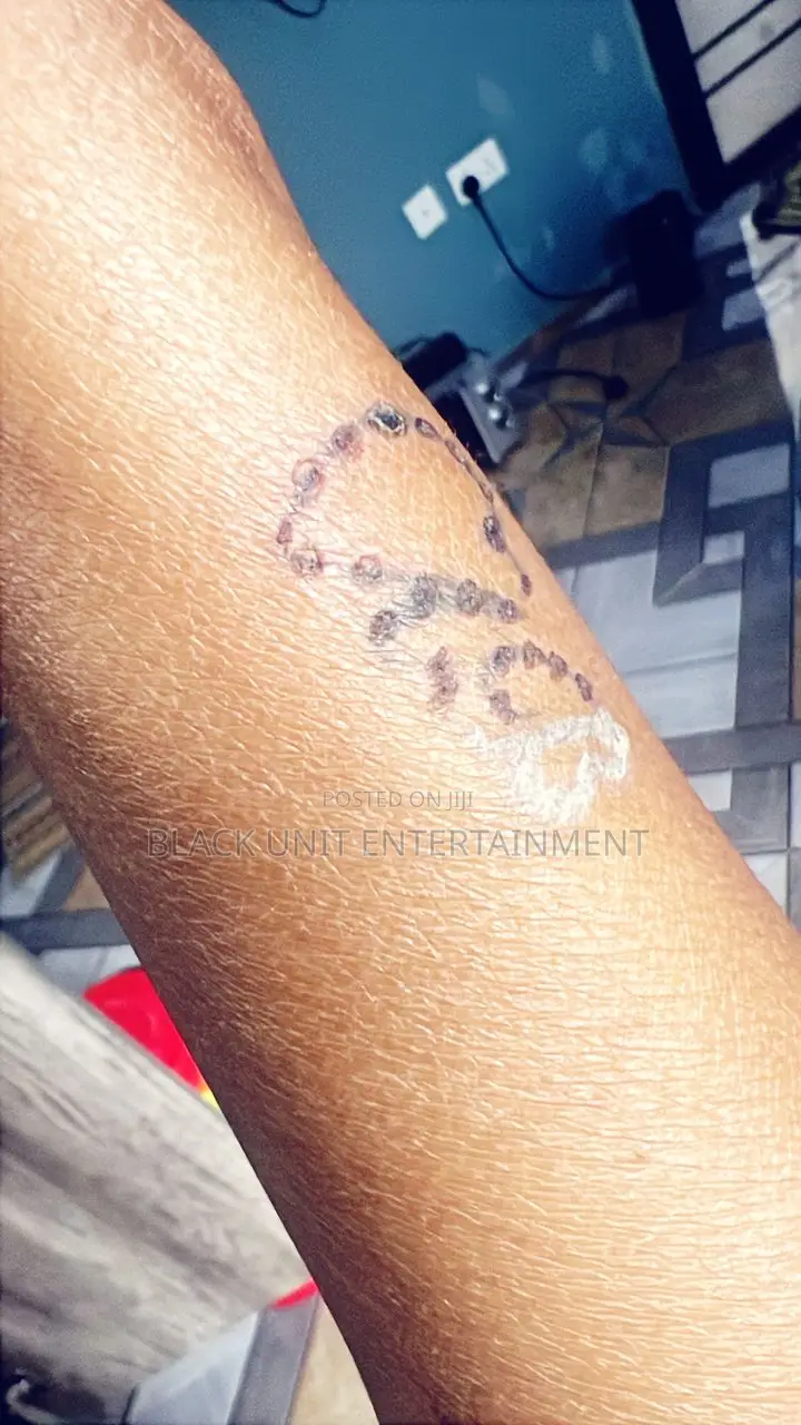 Tattoo Removal