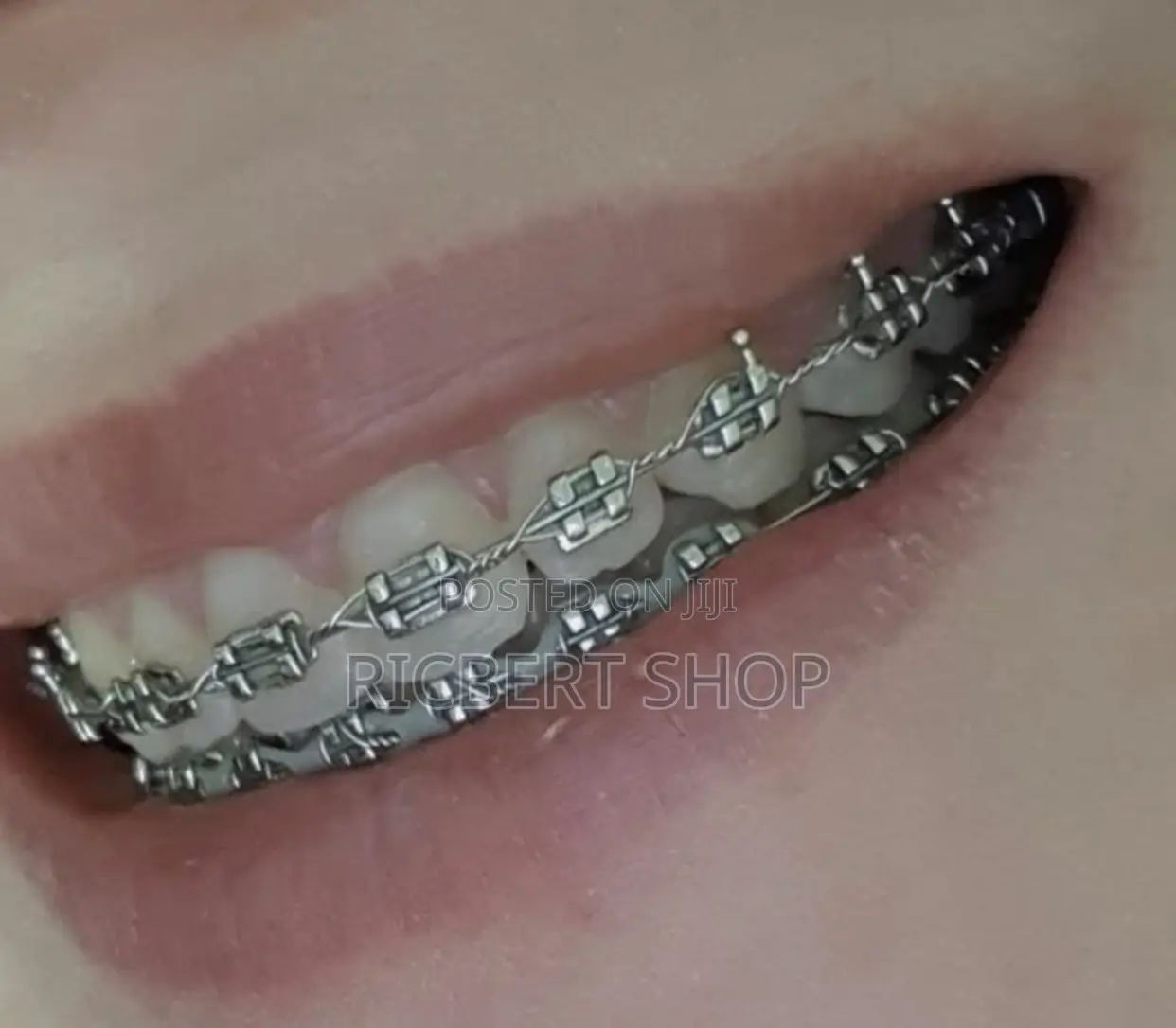Teeth Braces