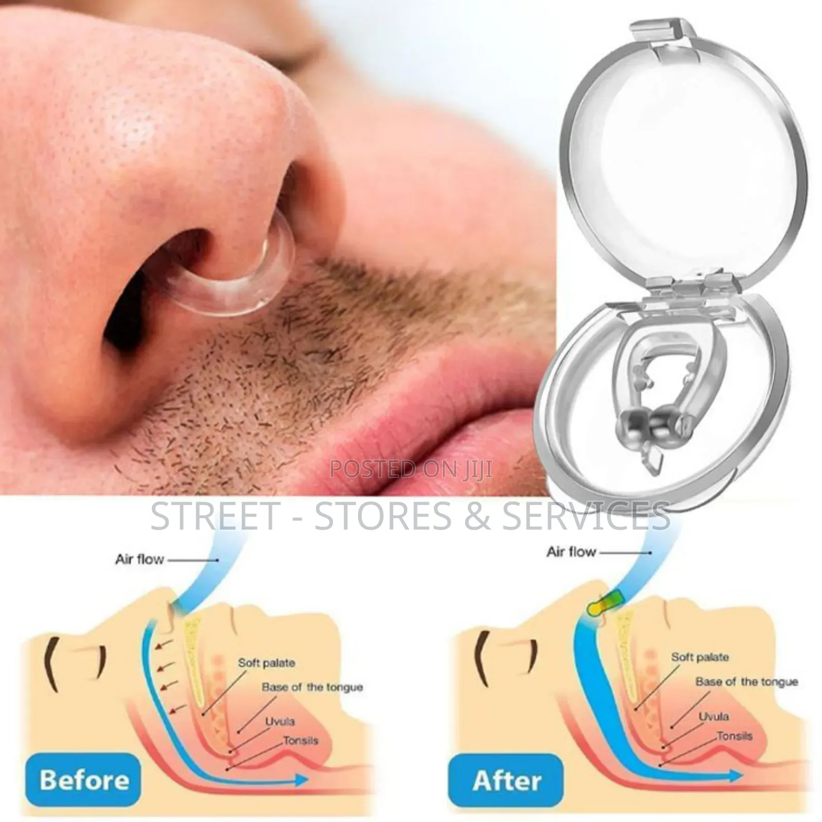 Anti Snoring Device
