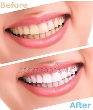 Super Effective Teeth Whitening Set
