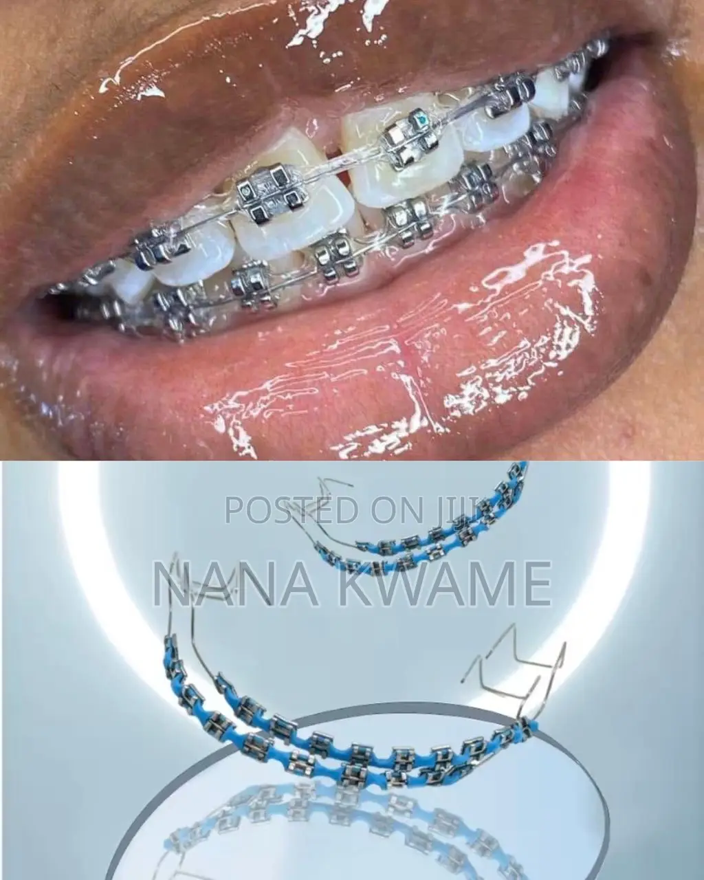 Clip On Dental Braces