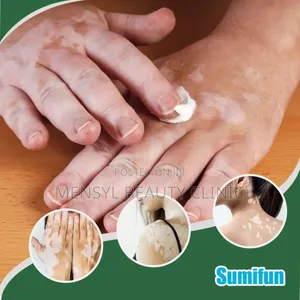 Vitiligo Cream Reduces White Spots on Skin