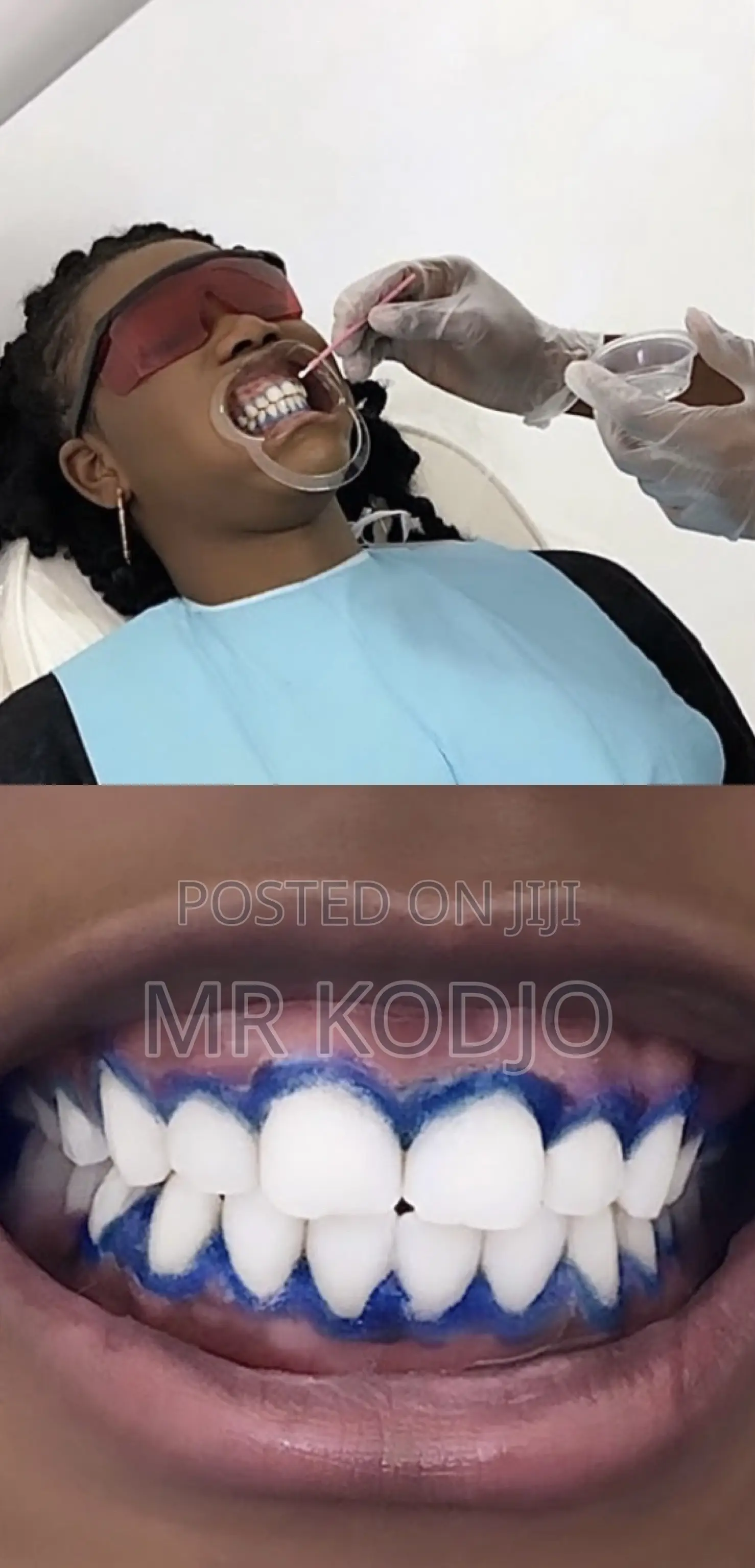 Teeth Whitening Service