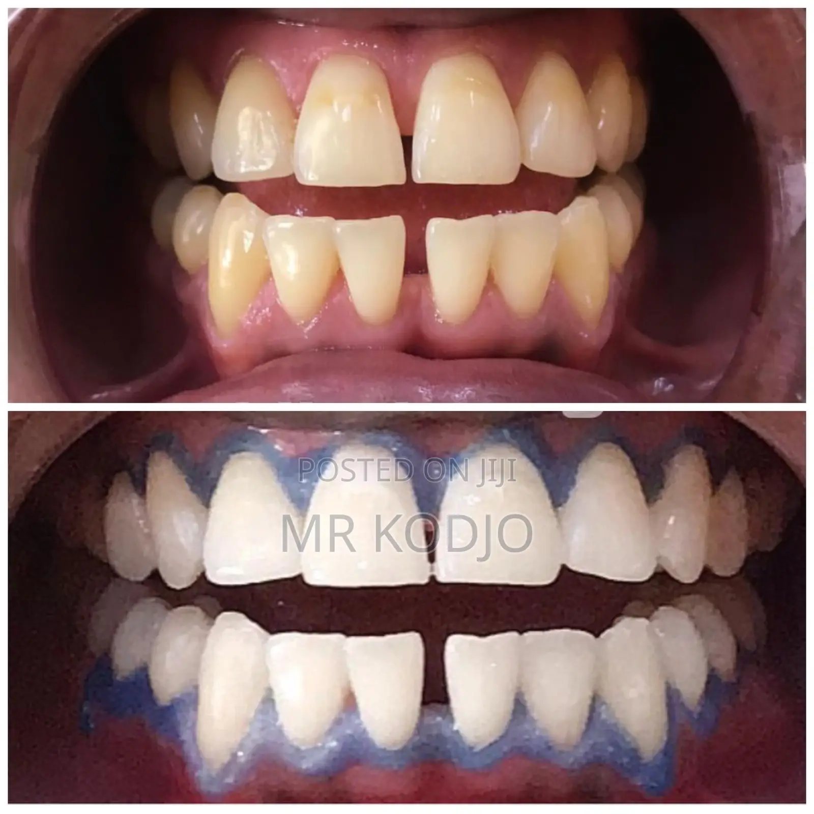 Teeth Whitening Service