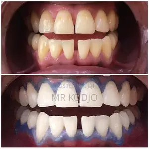 Teeth Whitening Service