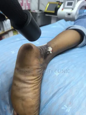 Laser Scar, Hair Removal, and Pigmentation Removal