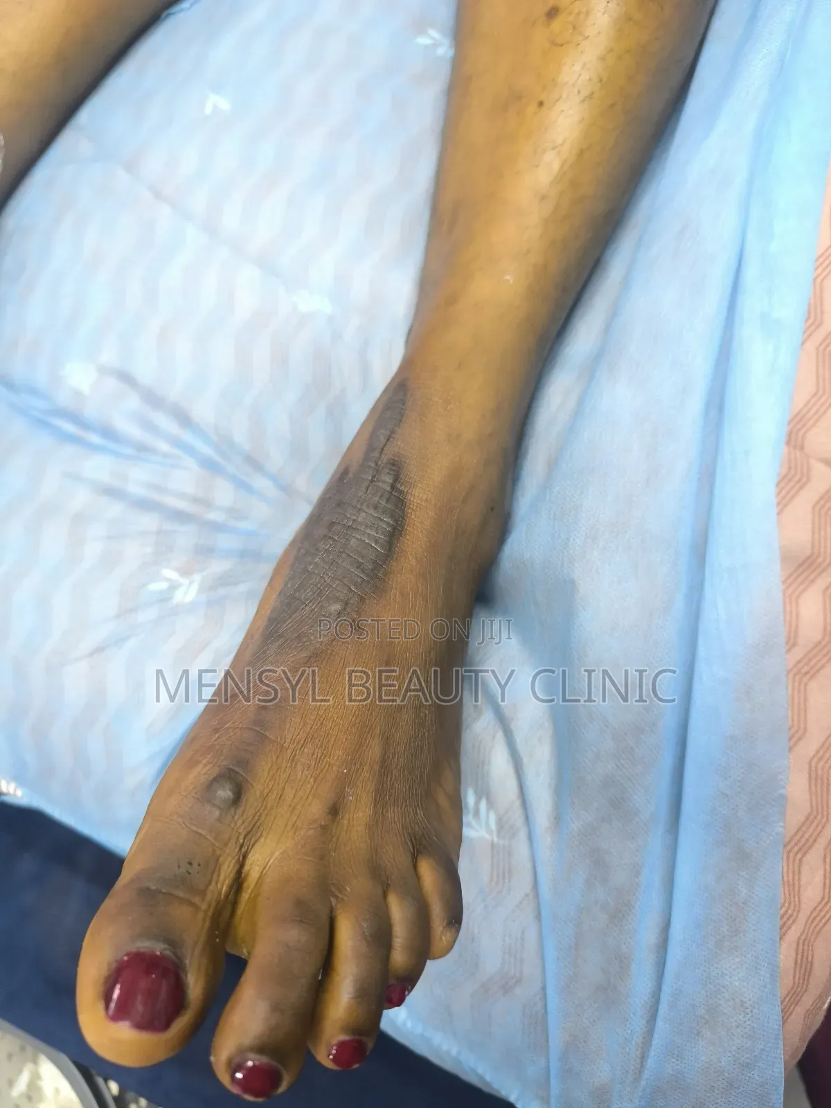 Laser Scar, Hair Removal, and Pigmentation Removal