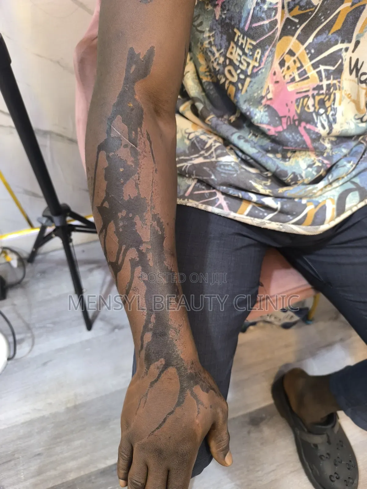 Laser Scar, Hair Removal, and Pigmentation Removal