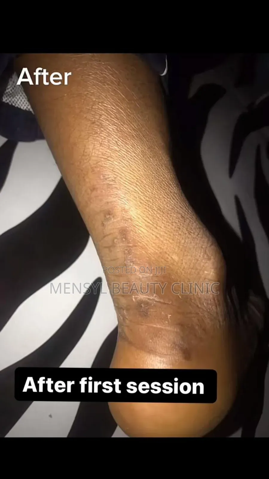 Laser Scar, Hair Removal, and Pigmentation Removal