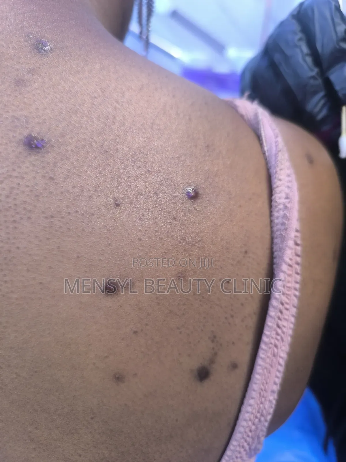 Laser Scar, Hair Removal, and Pigmentation Removal