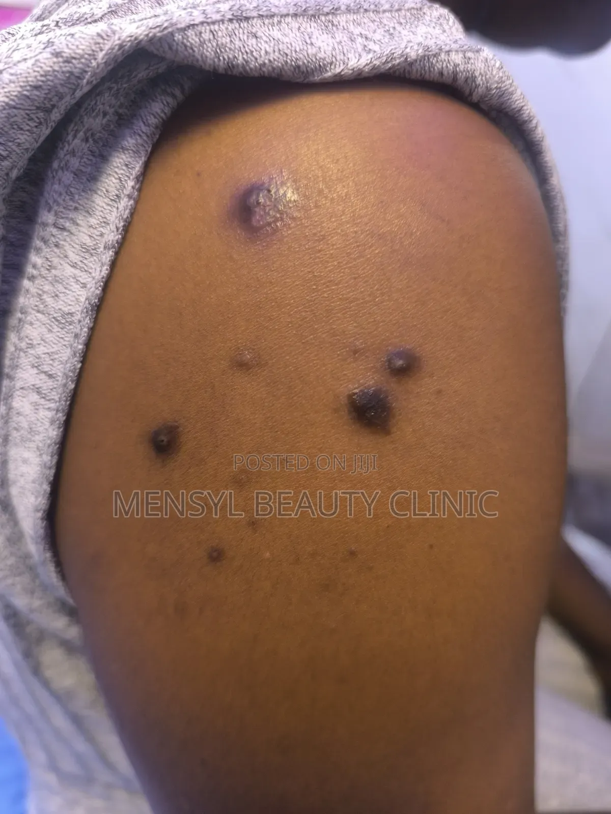Laser Scar, Hair Removal, and Pigmentation Removal