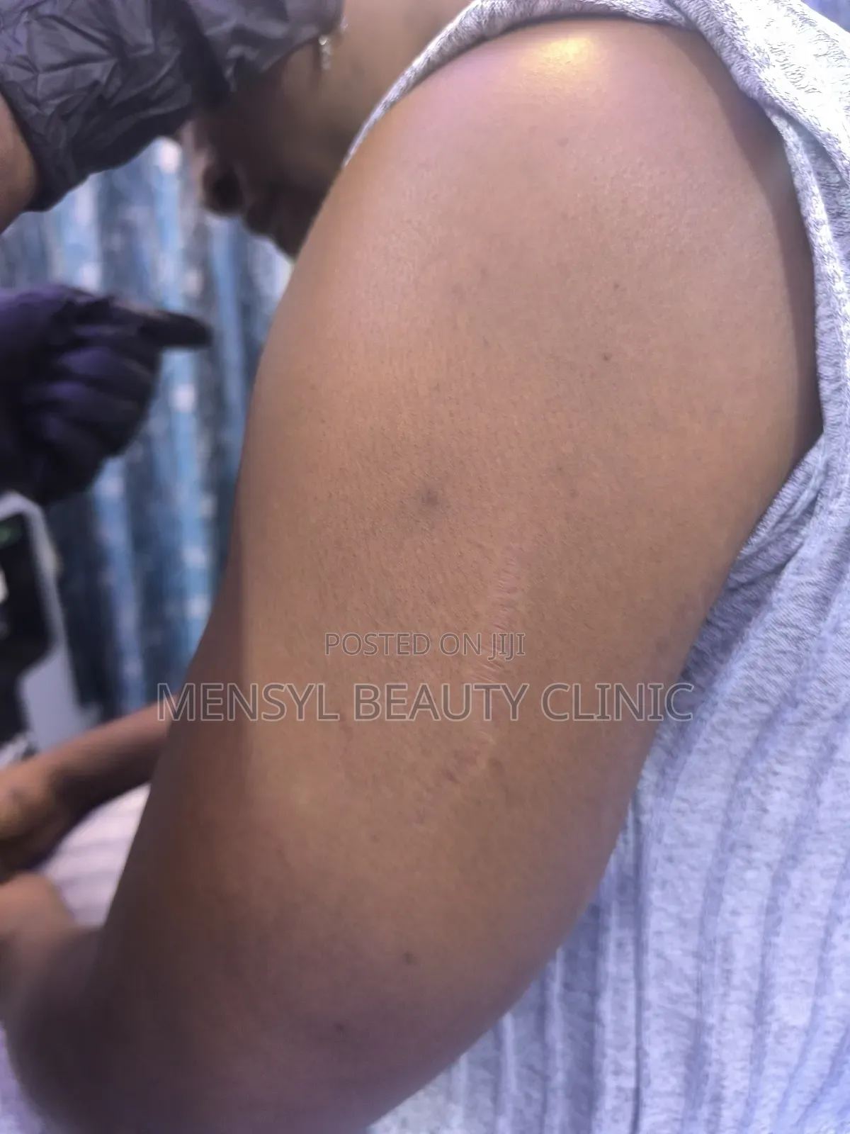 Laser Scar, Hair Removal, and Pigmentation Removal